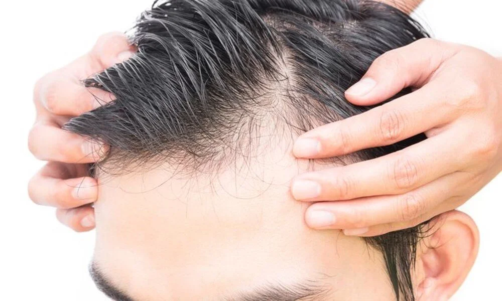 Erkeklerde saç dökülmesini engellemek