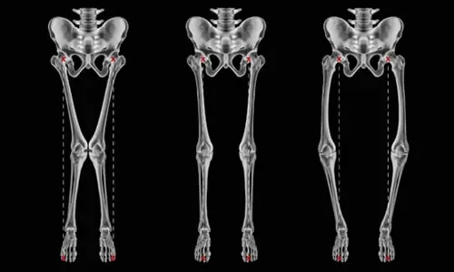 Çarpık Bacak Sorunu ve Tedavisi: “Görünüş Meselesi” Değil, Yük Dağılımı Meselesi 1 Çarpık Bacak